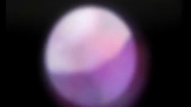 лейомиома влагалища, видеоассистированное удаление множественных образований смотреть онлайн