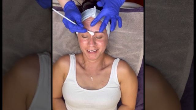 #TCA helps with hyperpigmentation, fine lines, scarring &texture. Down time 7-10 days #chemicalpeel смотреть онлайн