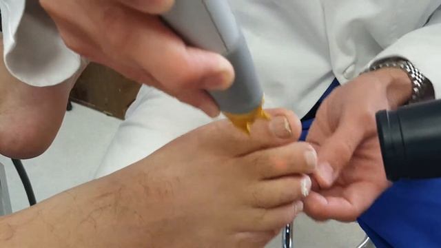 Laser Treatment of Fungal Toe Nail with a Cutera Laser смотреть онлайн