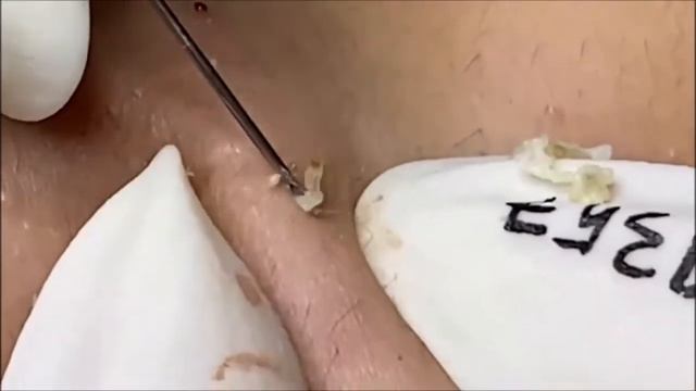 Relaxing Acne Treatment Acnes Treatment 130 смотреть онлайн