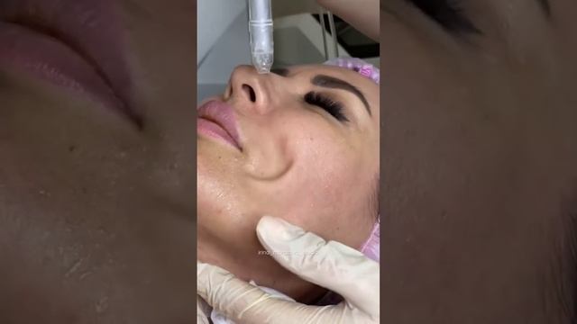 Газожидкостный пилинг. Аппаратная методика. смотреть онлайн