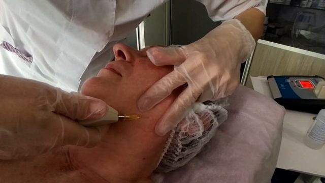 Карбокситерапия лица, шеи, зоны декольте в санатории Ясельда смотреть онлайн