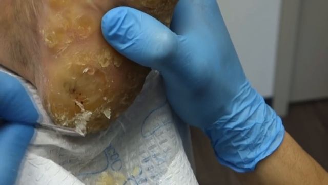 REMOVING EXTREMELY HARD FOOT CALLUS / CALLOUS!!! FOOT