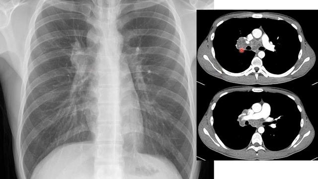 Tuberculosis and Chest radiographs смотреть онлайн