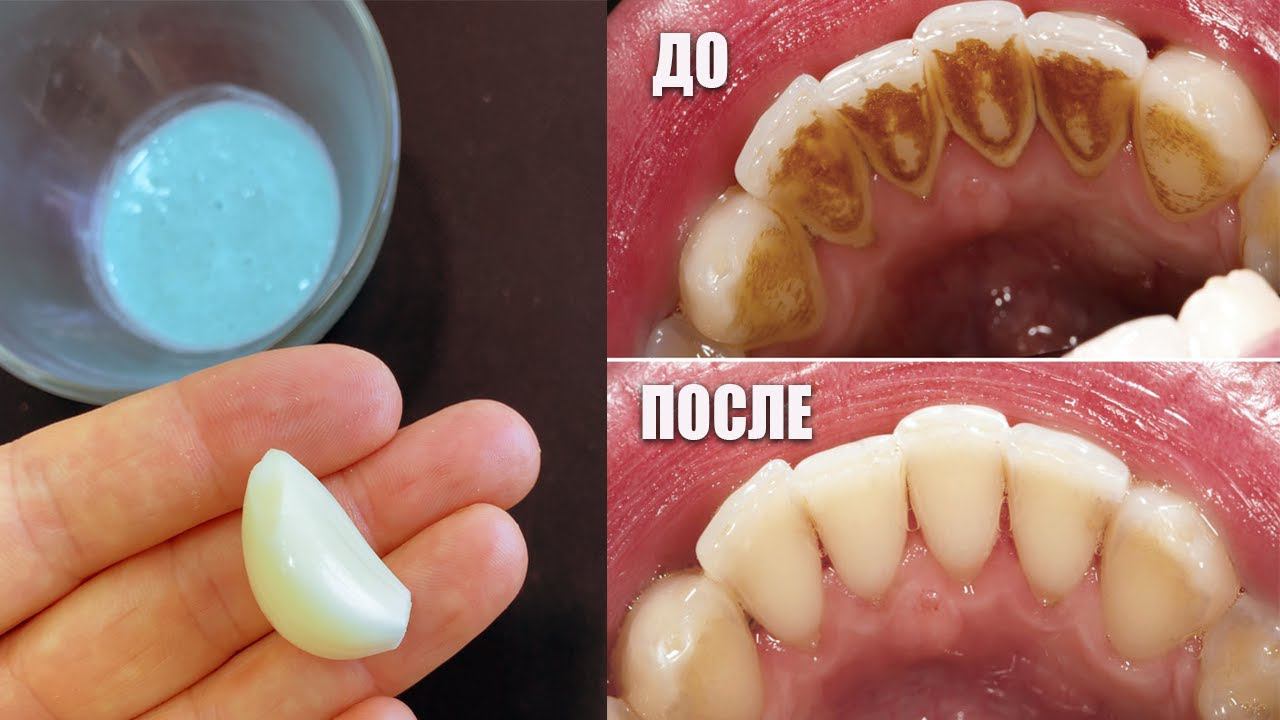 Отбеливание зубов в домашних условиях за 2 минуты. Как естественным образом отбелить желтые зубы смотреть онлайн