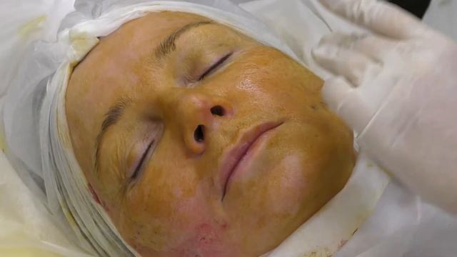 Постановка нитей EPITICON (Jetema, Южная Корея): лифтинг средней трети. смотреть онлайн