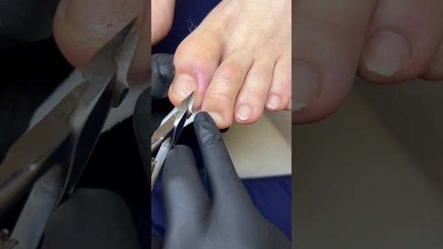 #подология #лечениеног #медицина #ноги #врастание #врастаниеногтя #подолог #спб #санктпетербург смотреть онлайн