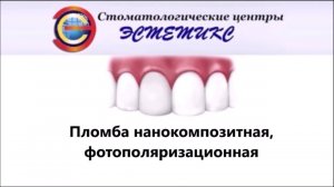 Пломба нанокомпозитная, фотополяризационная