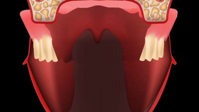 Мозоли на деснах - зубной протез