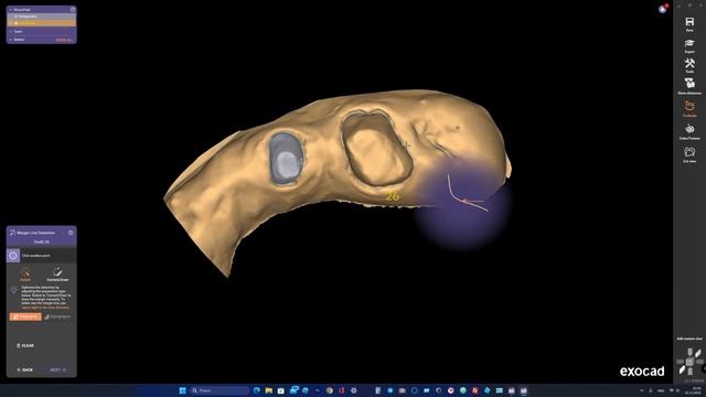 Scan to Medit T310, ExoCad invert impression, Model creator. смотреть онлайн