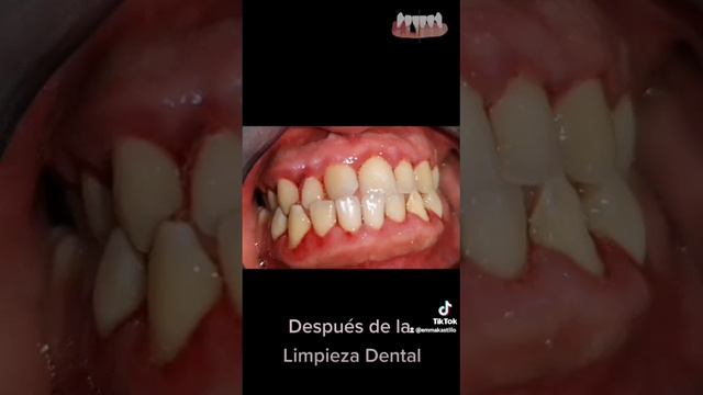 gingivitis смотреть онлайн