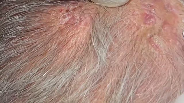 Scalp Scar Blackhead Extractions. Scar Tissue On Scalp Filling With Keratin Extracted. MrPopZit.