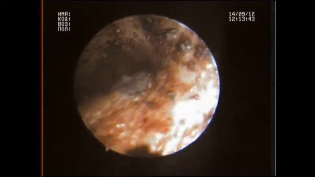 Отодектоз видиоотоскопия смотреть онлайн
