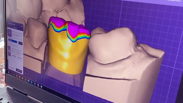 Безметалловые керамические коронки | Зуботехническая лаборатория смотреть онлайн