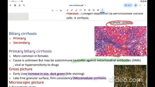 Lec 2 - Pathology - Liver cirrhosis, Portal hypertension & liver failure - GIT смотреть онлайн