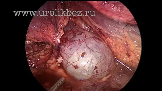 Retroperitoneal kidney cyst resection ретроперитонеоскопическая декортикация кисты почки смотреть онлайн