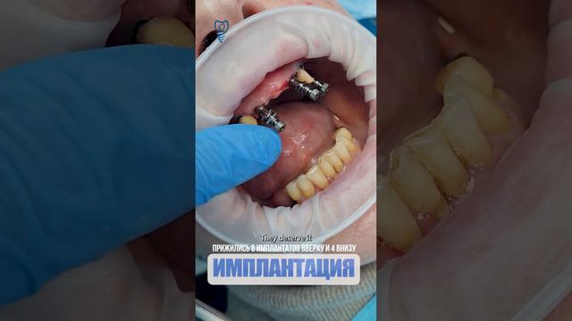 Прижились 8 имплантов на верху и 4 внизу. 8 implants at the top and 4 at the bottom. смотреть онлайн