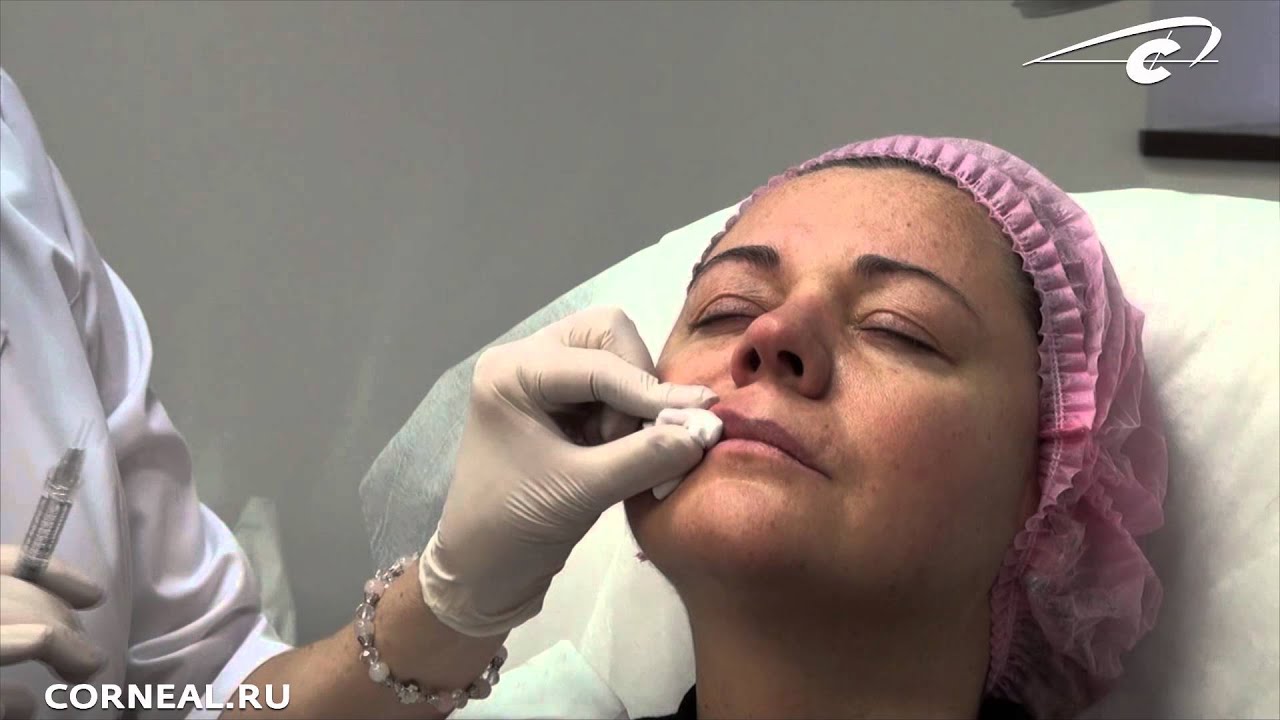 Губы. Первичная оценка. Коррекция. Princess Filler смотреть онлайн