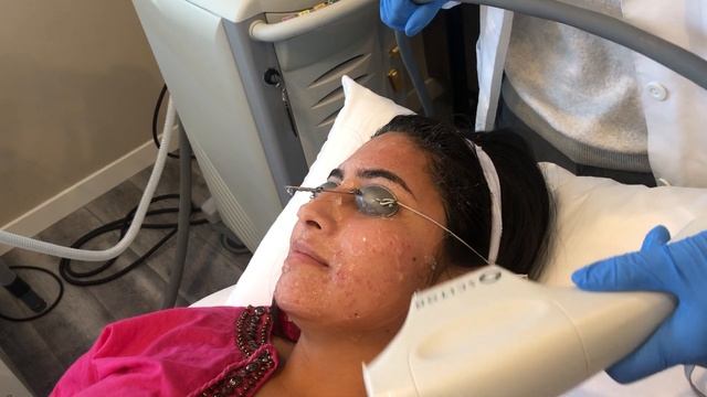 How I Cleared My Acne with Laser Treatment (BBL Forever Clear) смотреть онлайн