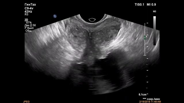 Аденома (гиперплазия) предстательной железы смотреть онлайн