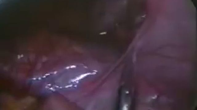 Лапароскопическая аппендэктомия