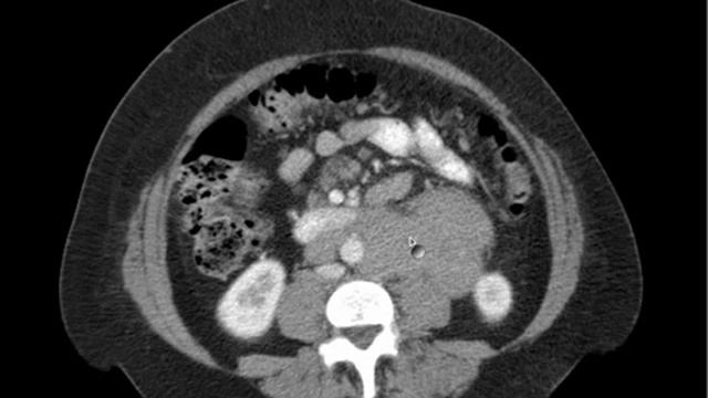 CT Abdomen Lymphadenopathy DISCUSSION.mp4 смотреть онлайн