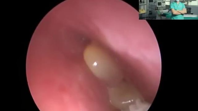 Большой полип в носу.Удаление под контролем эндоскопа
