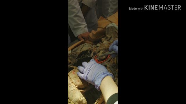 Topography of Mediastinum смотреть онлайн