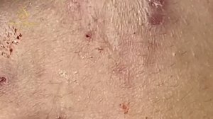 Professional bleckheads   Выдавливание черных точек прыщей   самое залипательное видео 2023