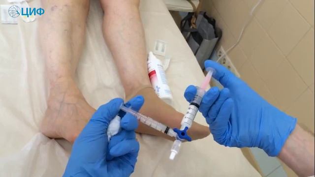 Центр Инновационной Флебологии Склеротерапия смотреть онлайн
