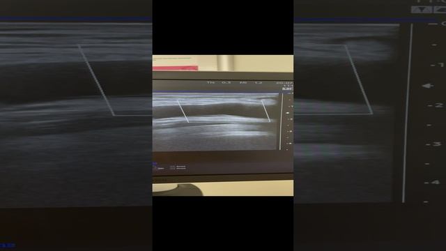 Как выглядит атеросклероз на узи. Узи артерий. Флеболог Москва смотреть онлайн