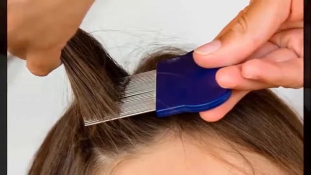 Как избавиться от мертвых и живых гнид, способы убрать их с волос