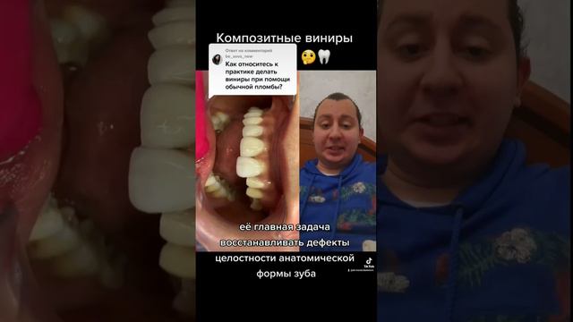 Хороши ли композитные виниры?🤔🦷 #стоматолог #дантист #стоматология #зубнойврач #виниры #винирыназуб