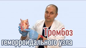 Тромбоз геморроидальных узлов #проктолог #проктология #врач #геморрой #тромбоз #youtube #врачи