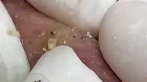 ВЫДАВЛИВАТЬ ПРИЩИ НА СТАРОЙ КОЖЕ/ДАВИЛКИ ПРИЩЕЙ