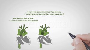 Замена аортального клапана