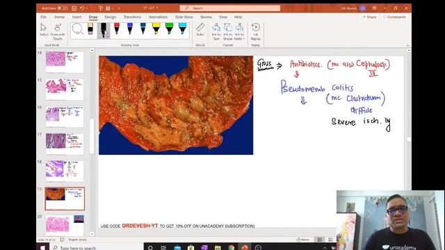 GIT Image discussion - Pathology | Dr. Devesh Mishra смотреть онлайн