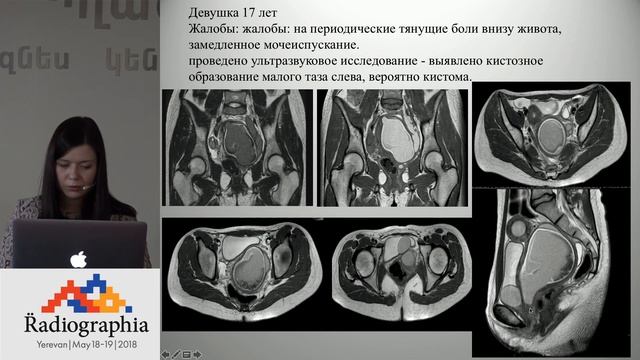 Ирина Анненкова. Дифференциальная диагностика кистозных образований малого таза у детей. смотреть онлайн