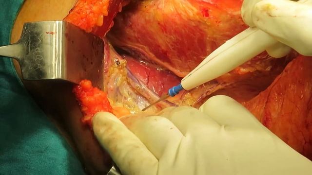 Axillary node dissection step by step смотреть онлайн