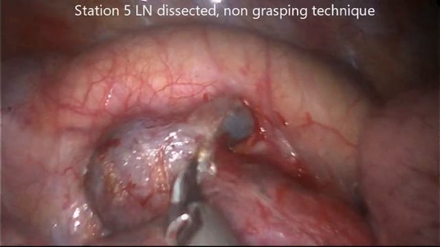 Tubeless Left UVATS Mediastinal Node Biopsy смотреть онлайн