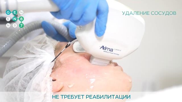 УДАЛИТЬ СОСУДЫ НА ЛИЦЕ Сеть клиник косметологии GEN87 смотреть онлайн
