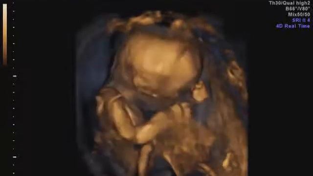 eden at 18wks (ultrasound) смотреть онлайн