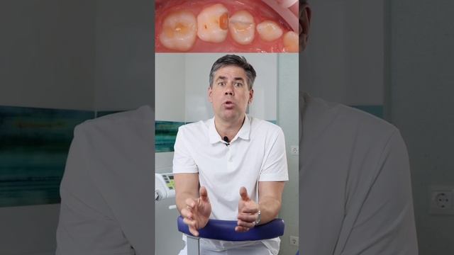 Это должен знать каждый родитель. Кариес молочного зуба начинается с этого! смотреть онлайн