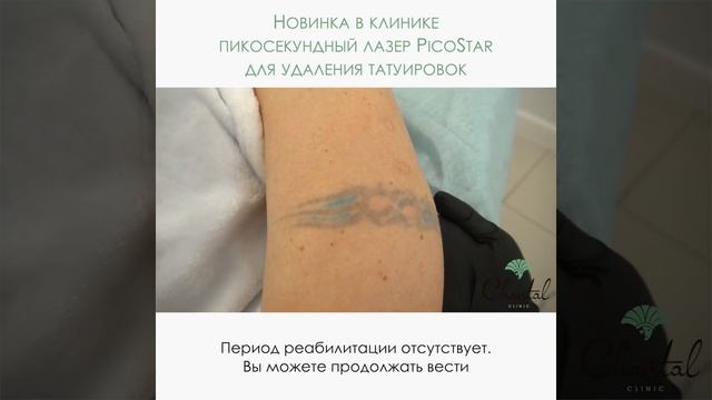 Процедура удаление татуировок аппаратом PicoStar смотреть онлайн