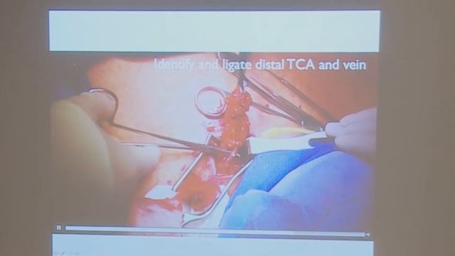 Supraclavicular Lymph Node Transfer - Dr. David Chang - Harvard Symposium смотреть онлайн