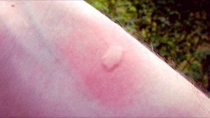 ЧТО БУДЕТ ЕСЛИ УКУСИЛ ОВОД ИЛИ СЛЕПЕНЬ