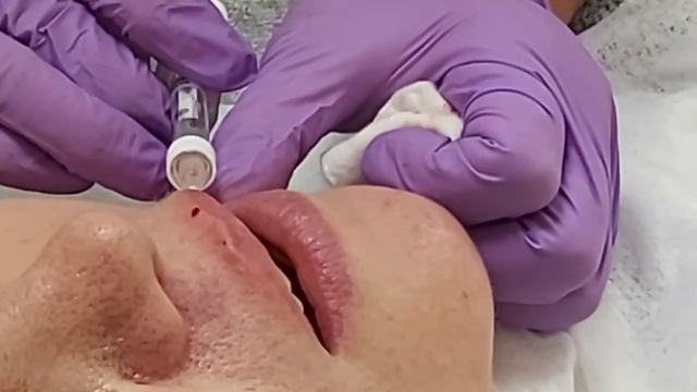 АирисКом студенты учатся: лёгкое увлажнение губ филером. смотреть онлайн