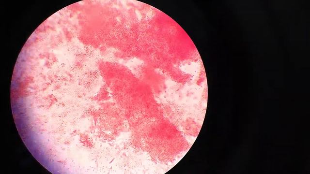 Klebsiella pneumonia смотреть онлайн
