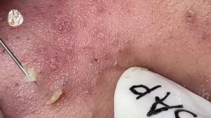 TREATMENT OF BLACKHEADS, HIDDEN ACNE IN THE MOUTH