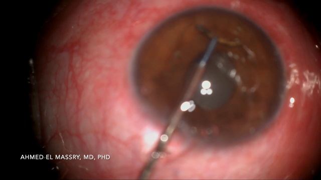 Angle foreign body смотреть онлайн